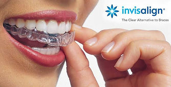Invisalign clear aligners orthodontic consultation