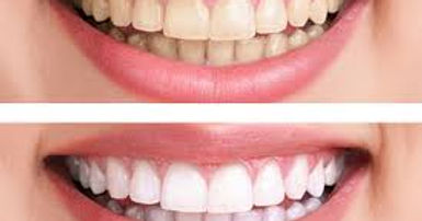 Clinical before and after smile transformation cases at The Hong Kong Japanese Dental Clinic - Complete Composite Smile Makeover