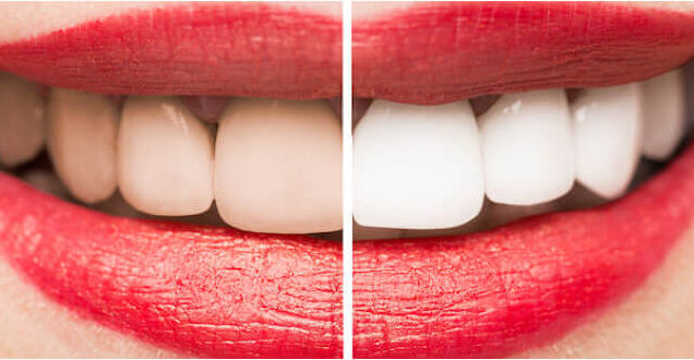 Clinical before and after smile transformation cases at The Hong Kong Japanese Dental Clinic - Aesthetic Enamel Restoration