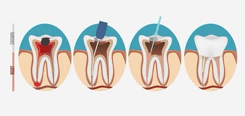 Conservative Root Canal Treatment