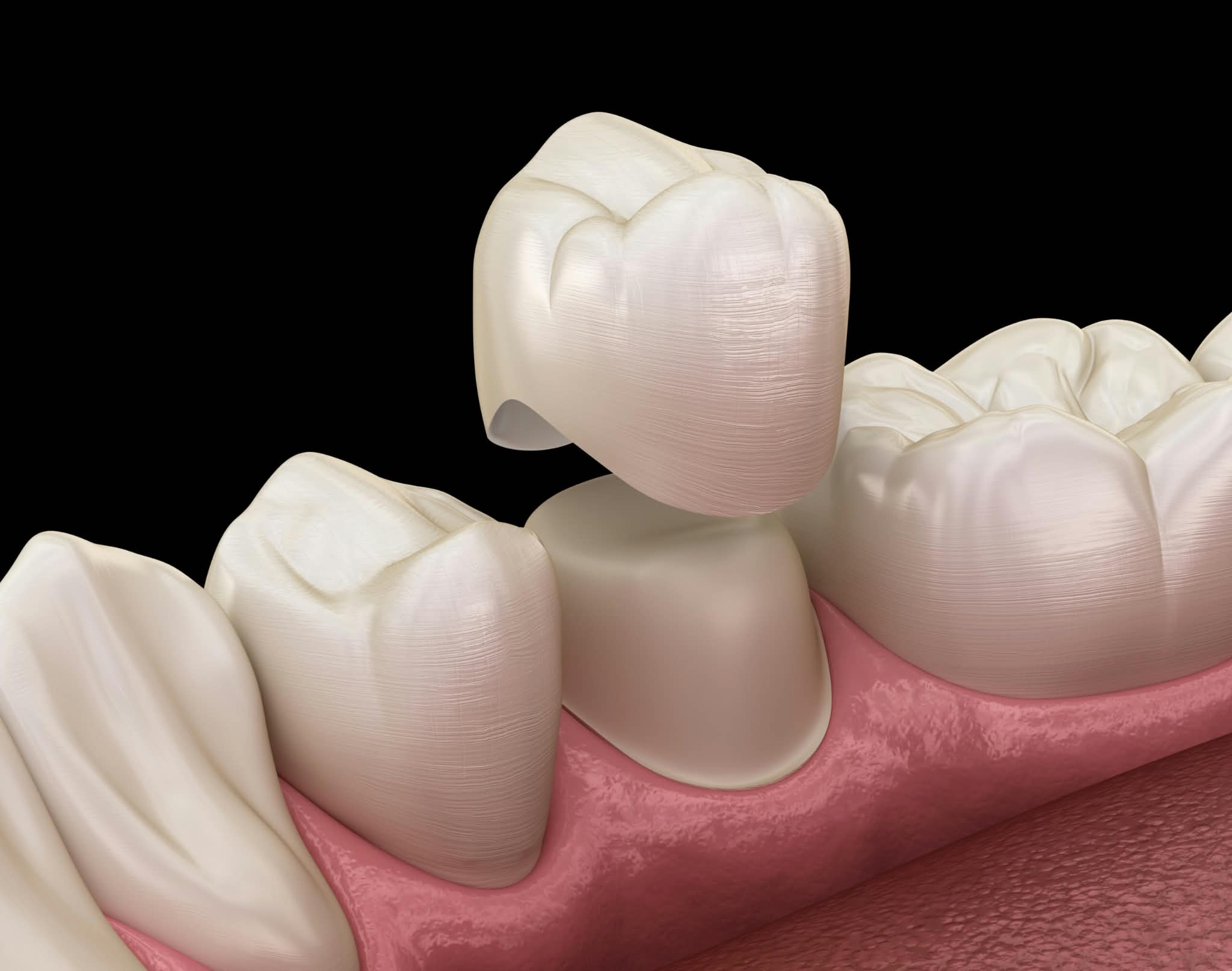 All-ceramic crowns and fixed bridges restorative service