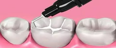 Preventive Fissure Sealants