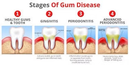Periodontal & Gum Disease Therapy