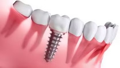 Restorative and Implants dental treatment
