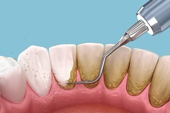 Scale and Polish (Professional Dental Cleaning)