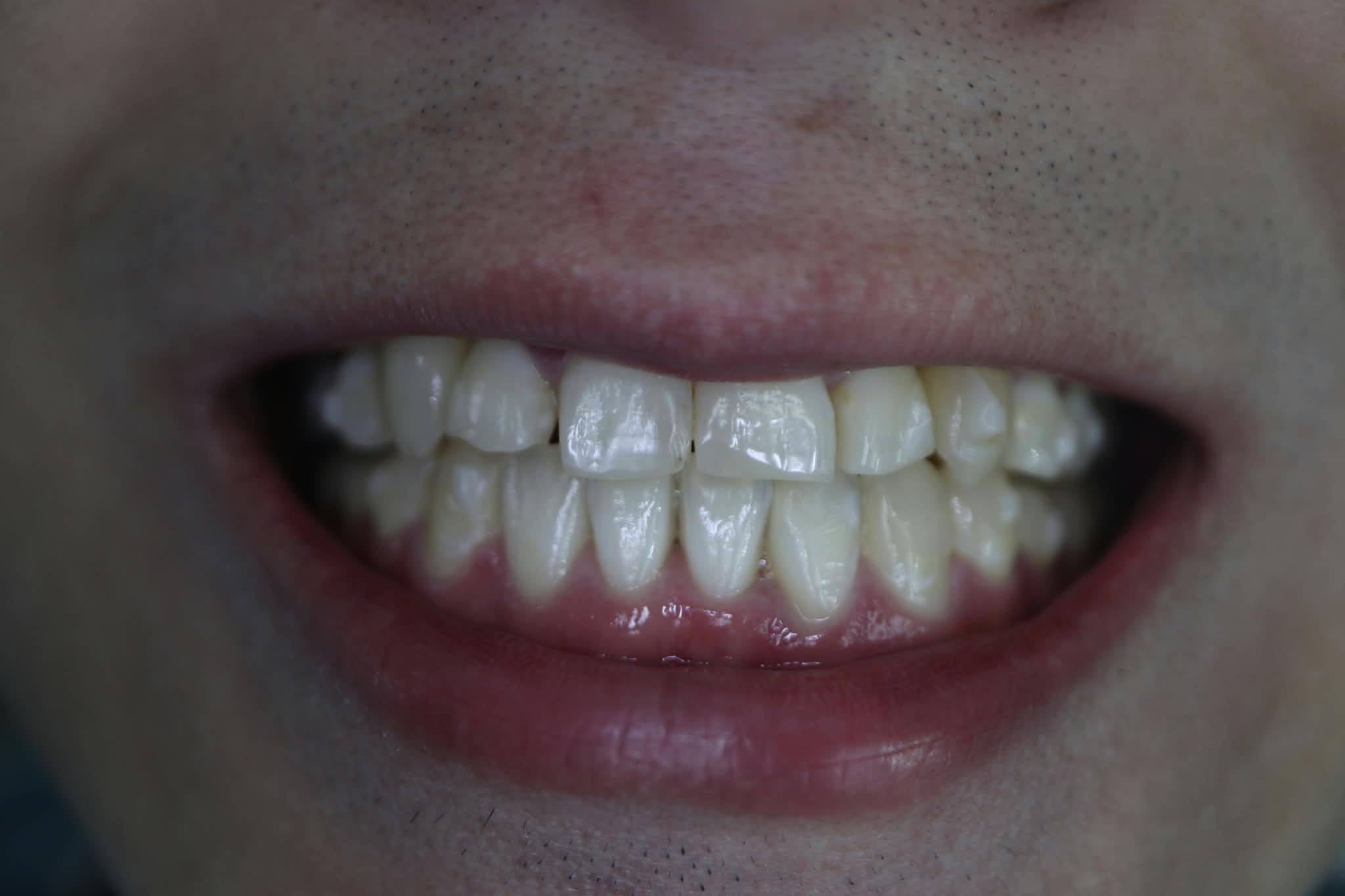 After: Corrected dental arch alignment following completed Invisalign aligner therapy