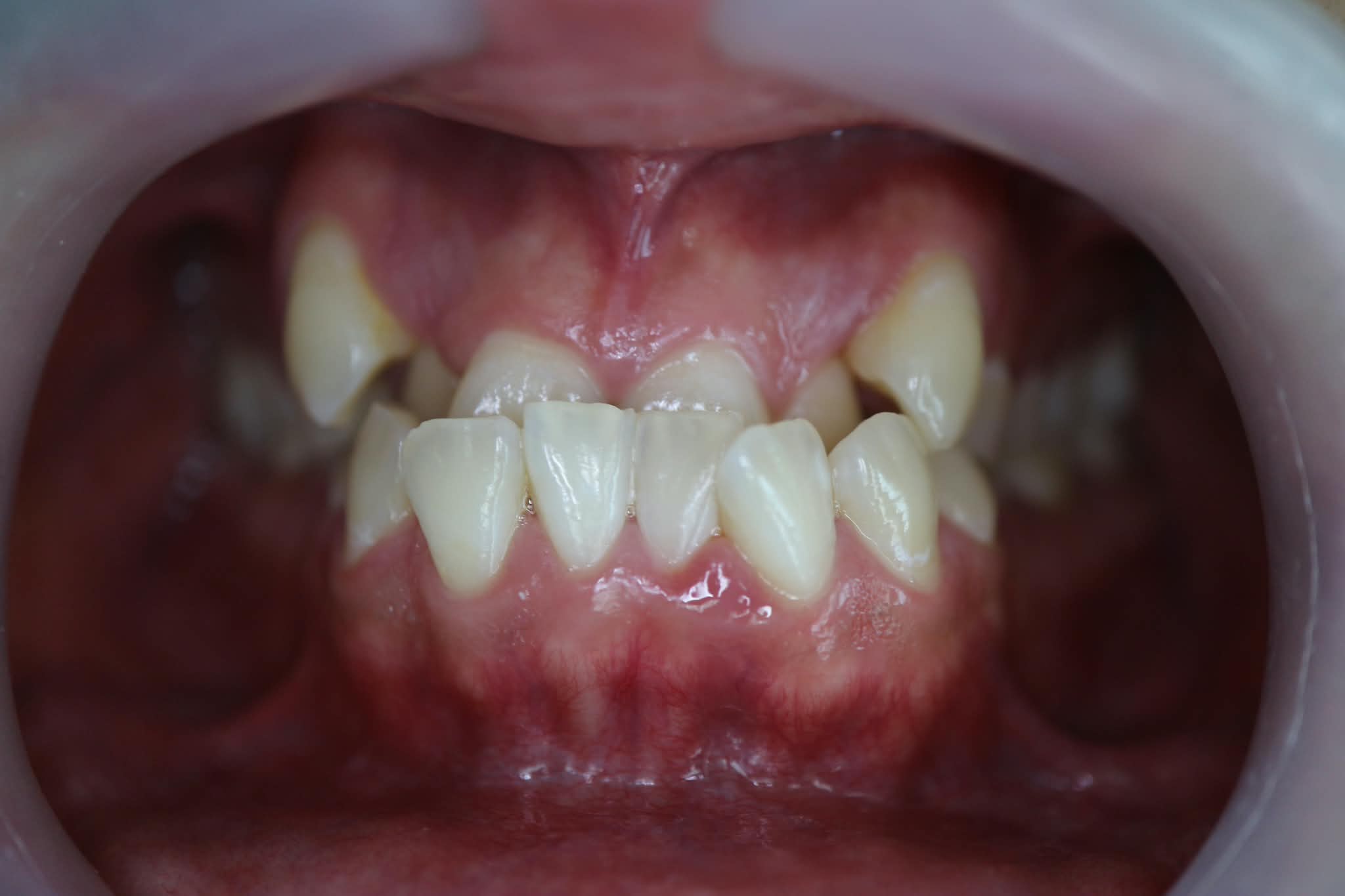 Before: Severe dental arch crowding and misalignment prior to Invisalign