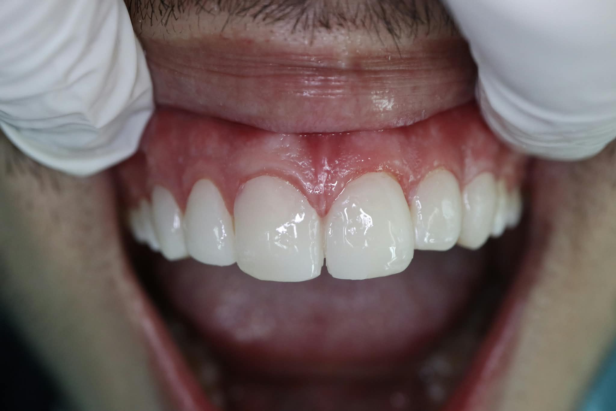 After: Seamless diastema closure with conservative composite layering