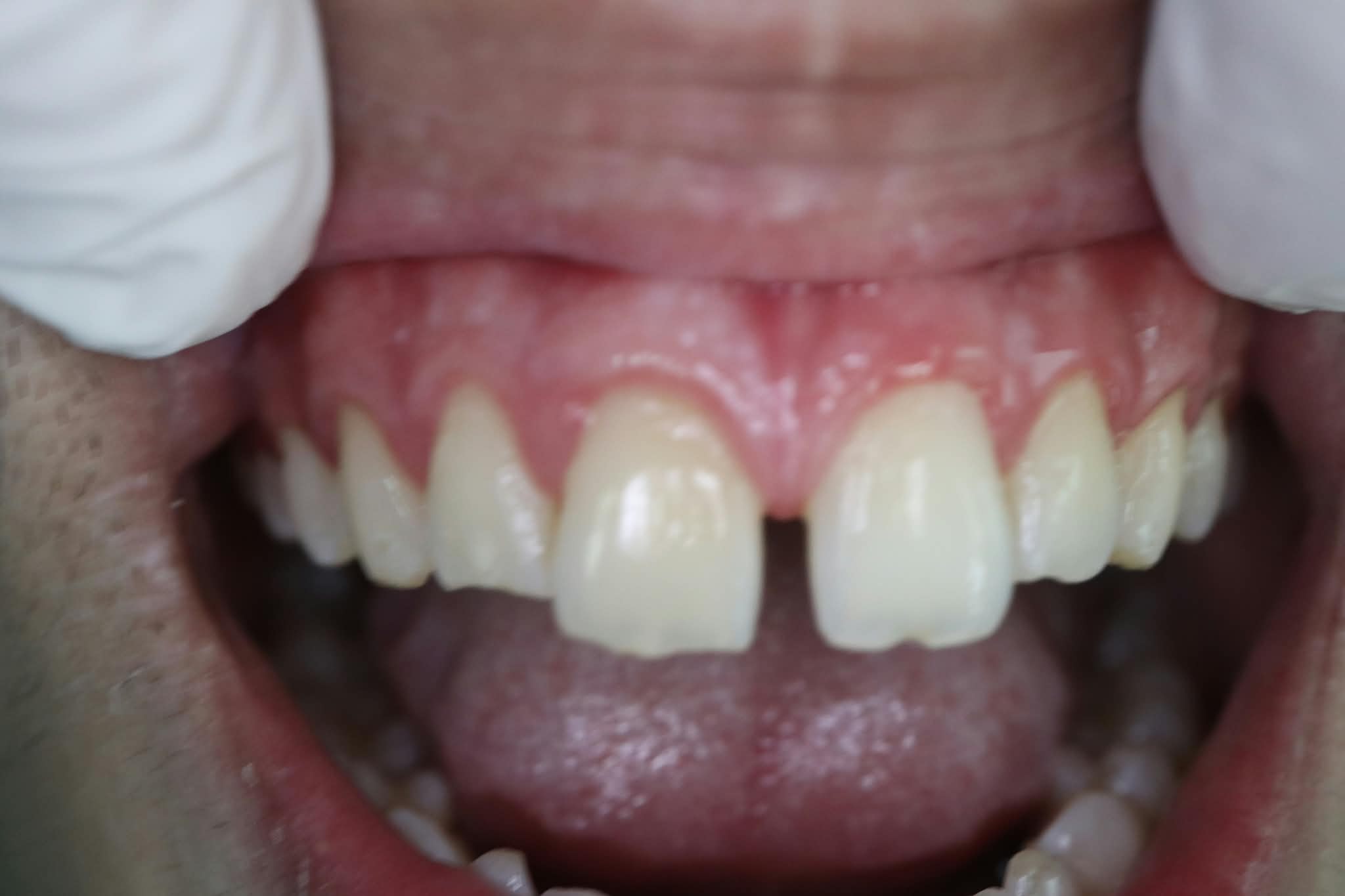 Before: Anterior midline diastema gap between upper incisors