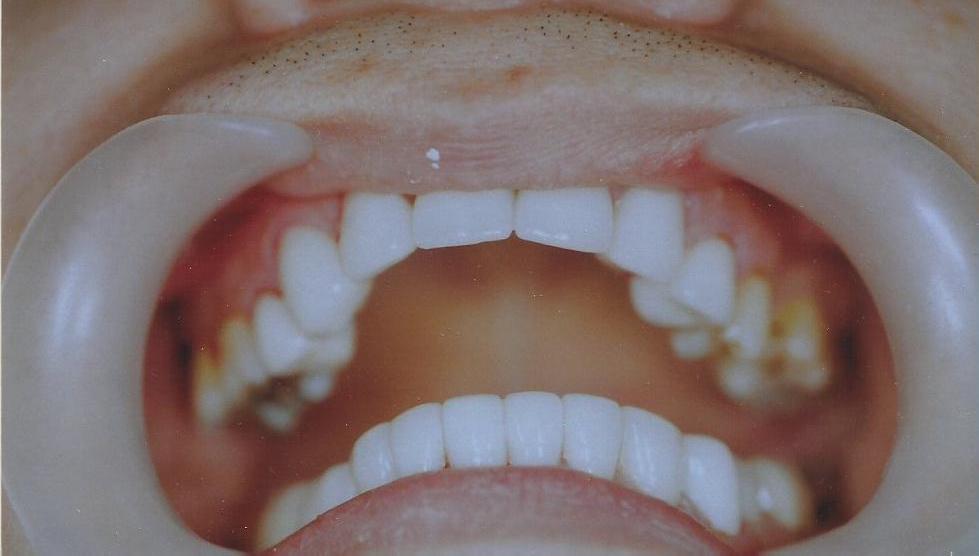 After: Restored mandibular teeth with custom-shaded subgingival Emax crowns matching adjacent teeth