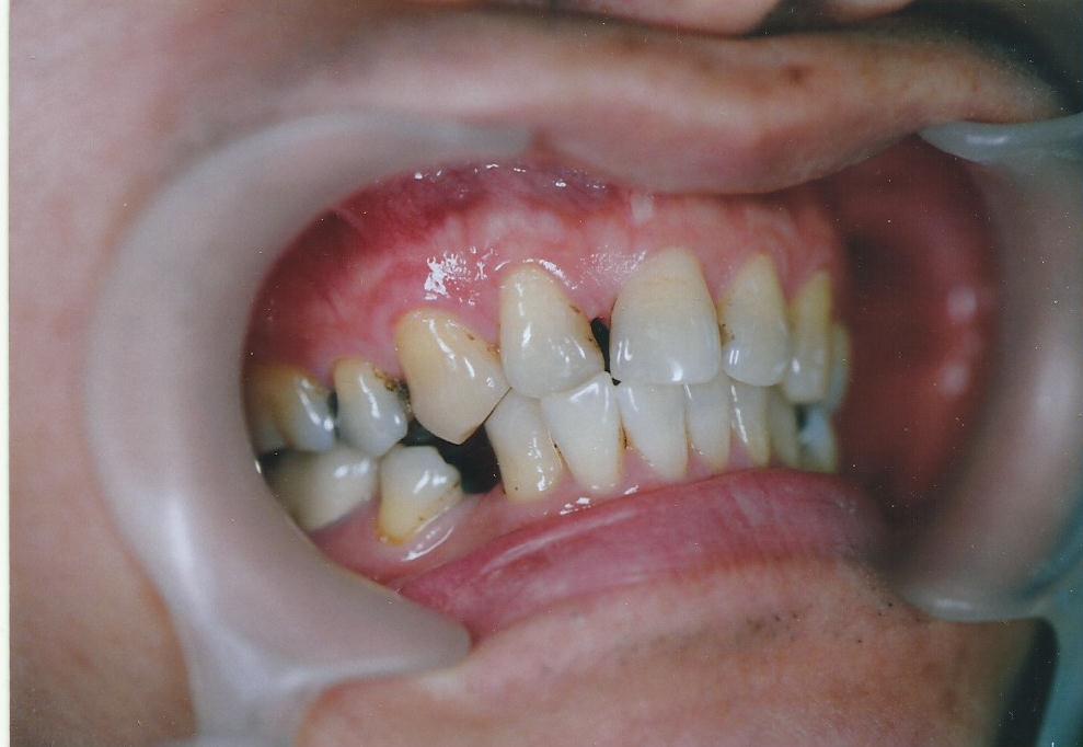 Before: Mandibular teeth prior to Emax ceramic crown restoration