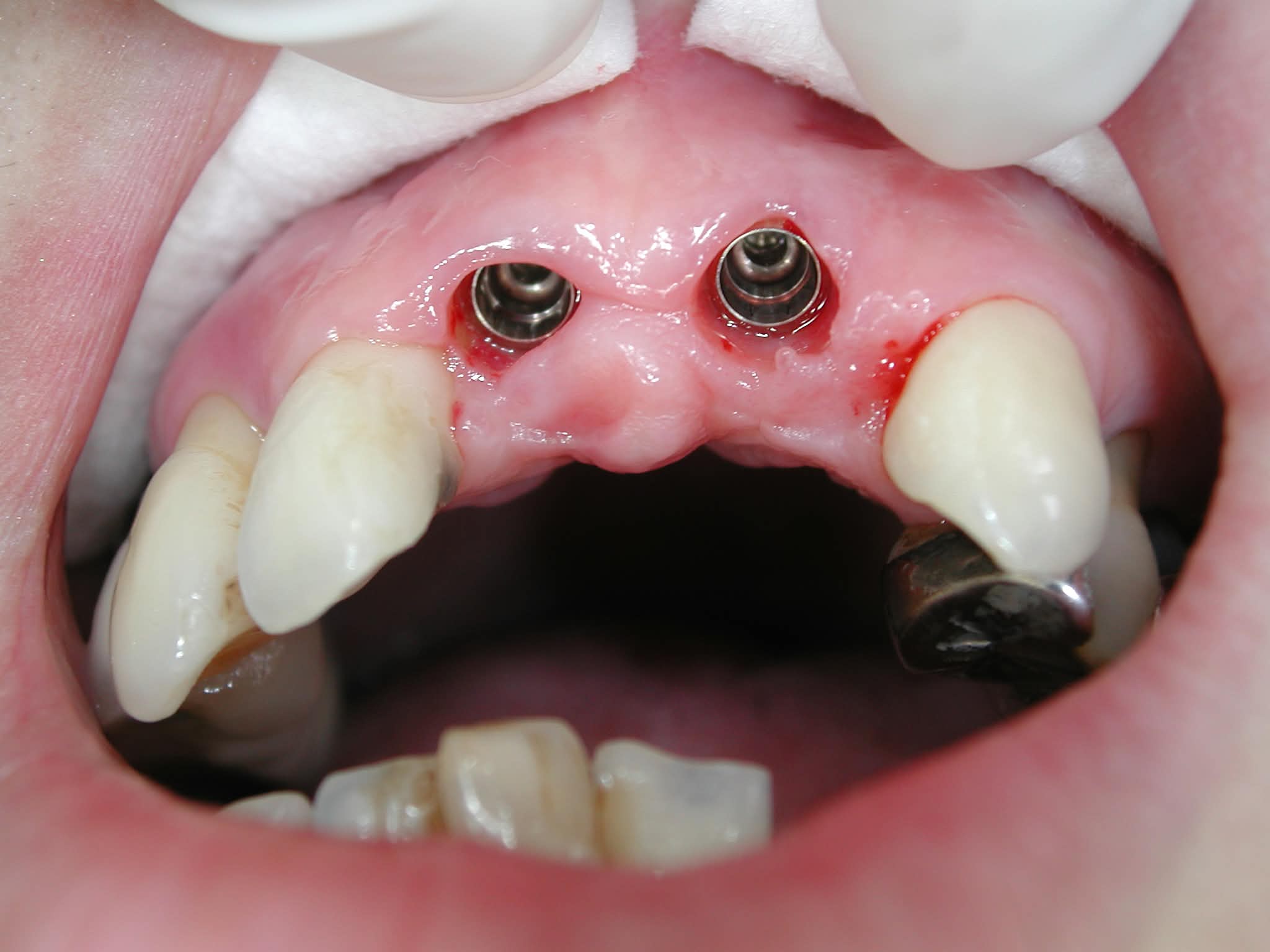 Before: Missing front maxillary incisors prior to dental implant placement
