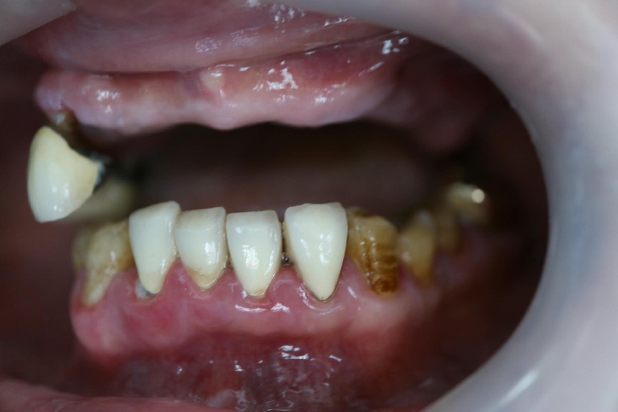 Before: Missing maxillary teeth prior to multiple dental implant placement