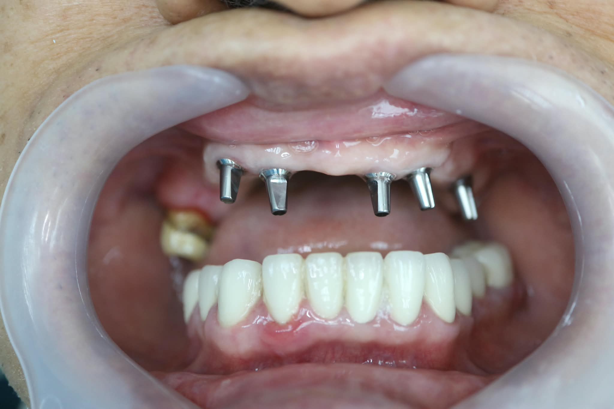 Procedure: Placement of biocompatible implant fixtures for multiple teeth replacement