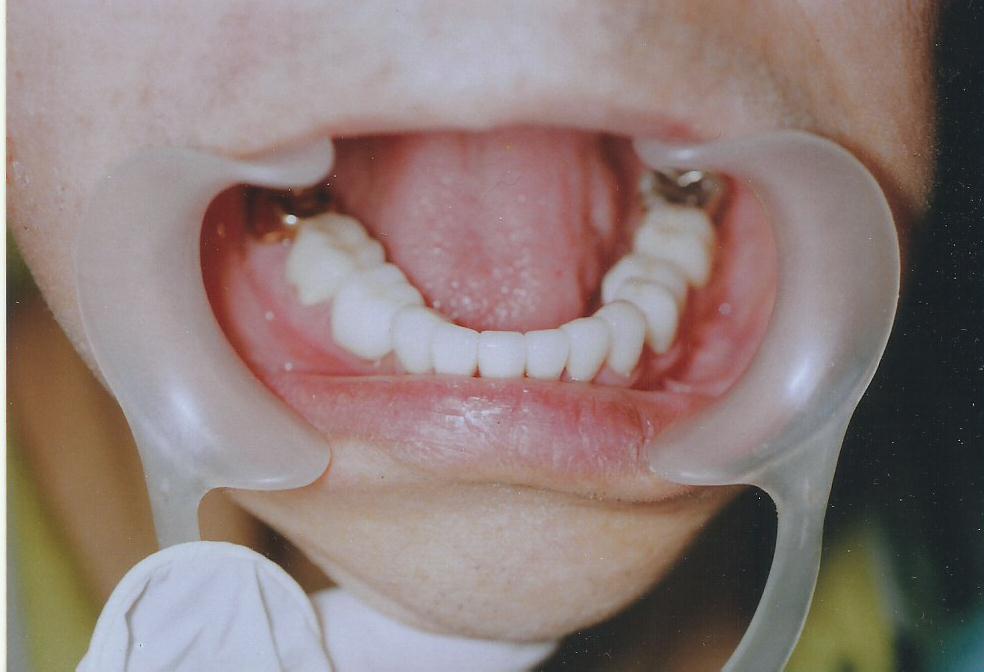 After: Restored mandibular teeth with custom-shaded subgingival Emax crowns matching adjacent teeth