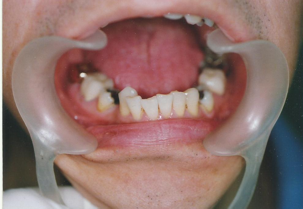 Before: Mandibular teeth prior to Emax ceramic crown restoration