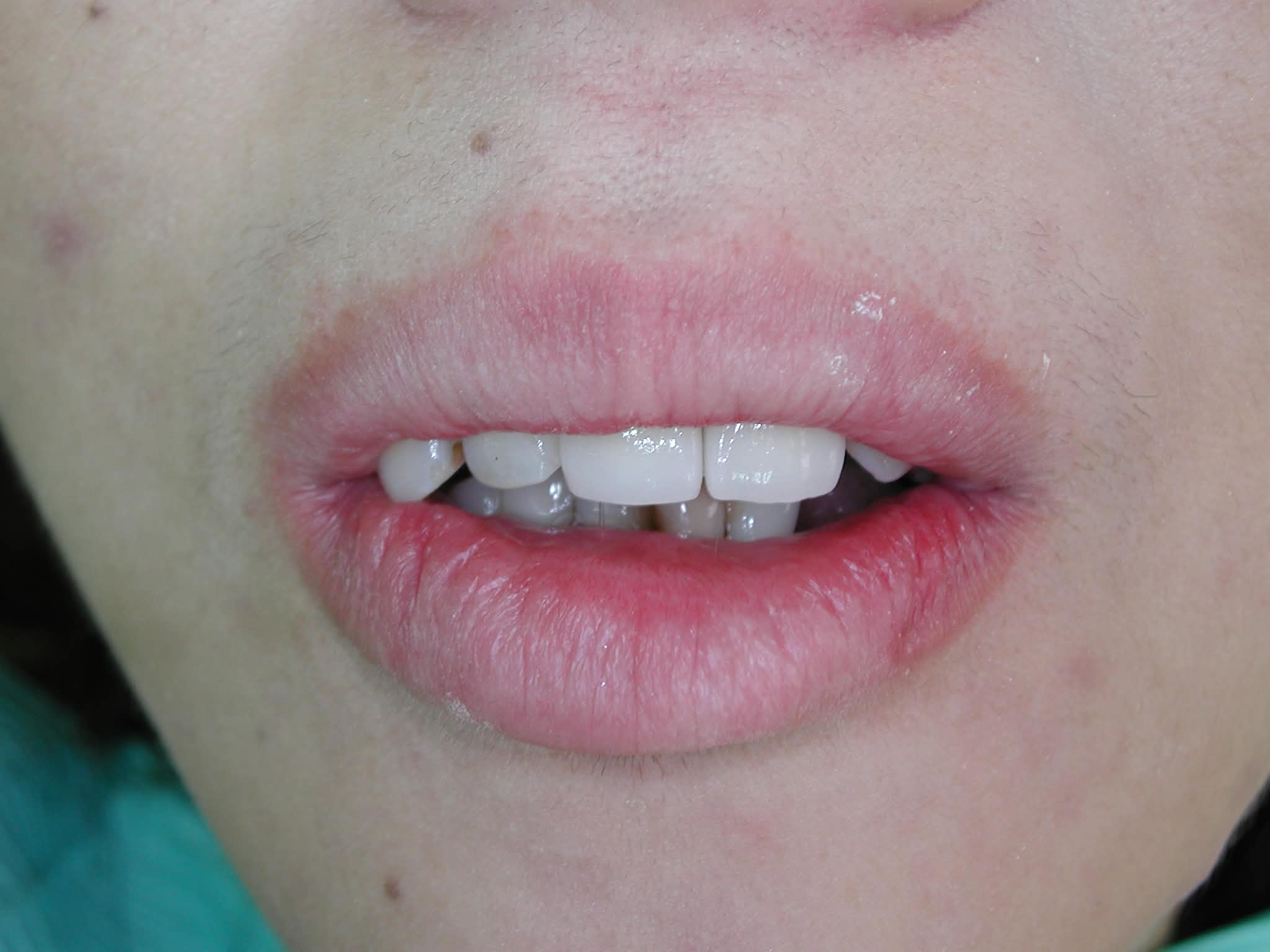 After: Restored front maxillary incisors with Zirconia crowns following implant procedure