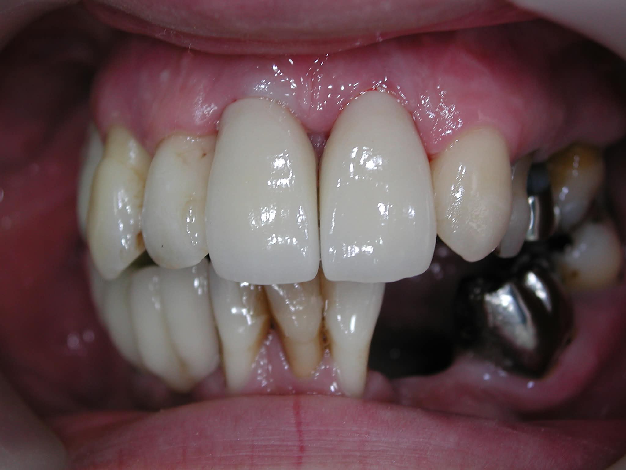 Procedure: Placement of biocompatible implant fixtures for two front teeth replacement