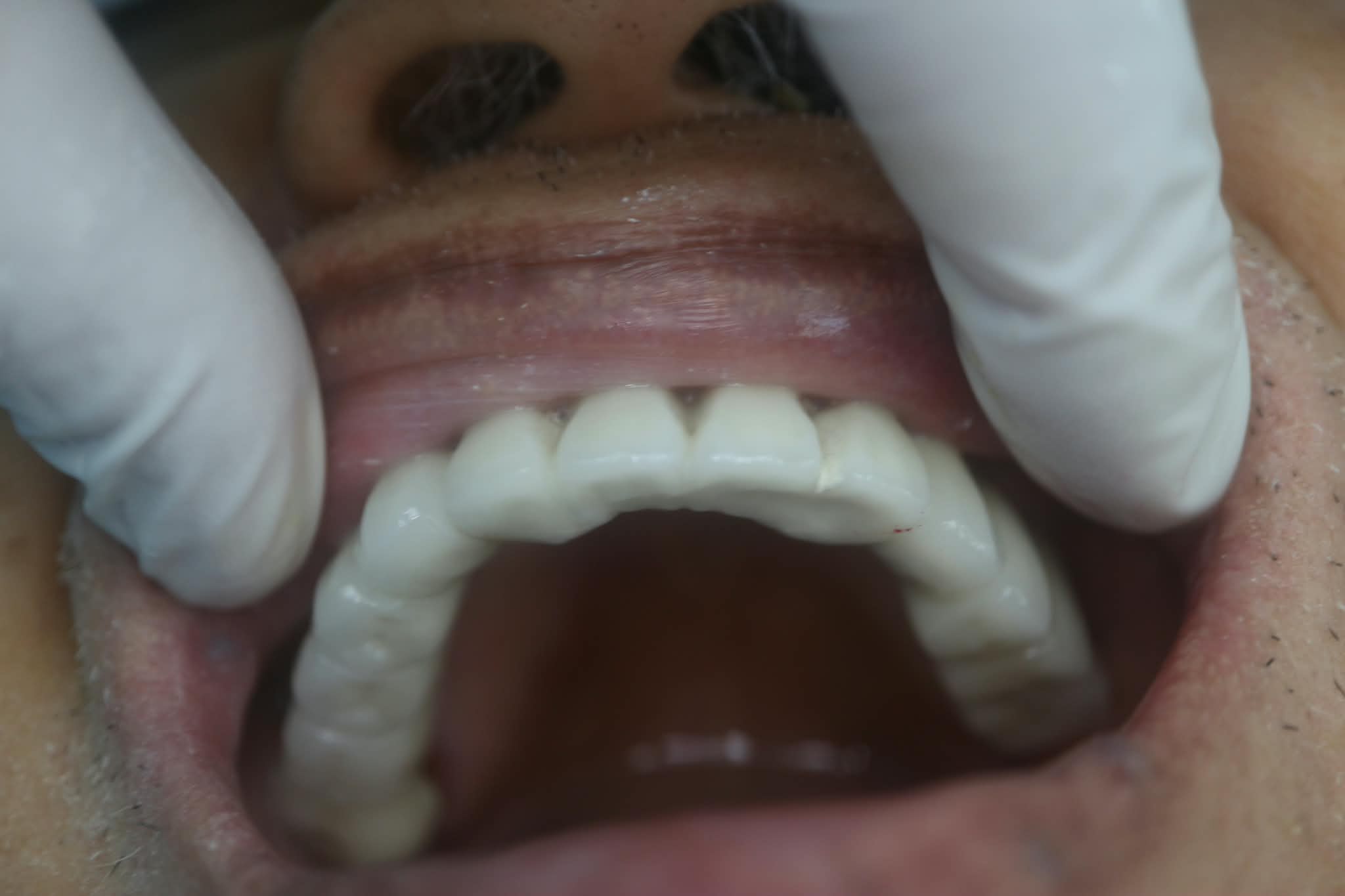 After: Restored maxillary units with Zirconia crowns following multiple implant procedure