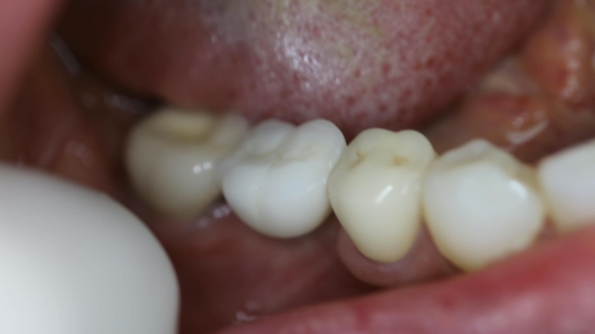 After: Restored molar with Zirconia crown following single tooth implant procedure