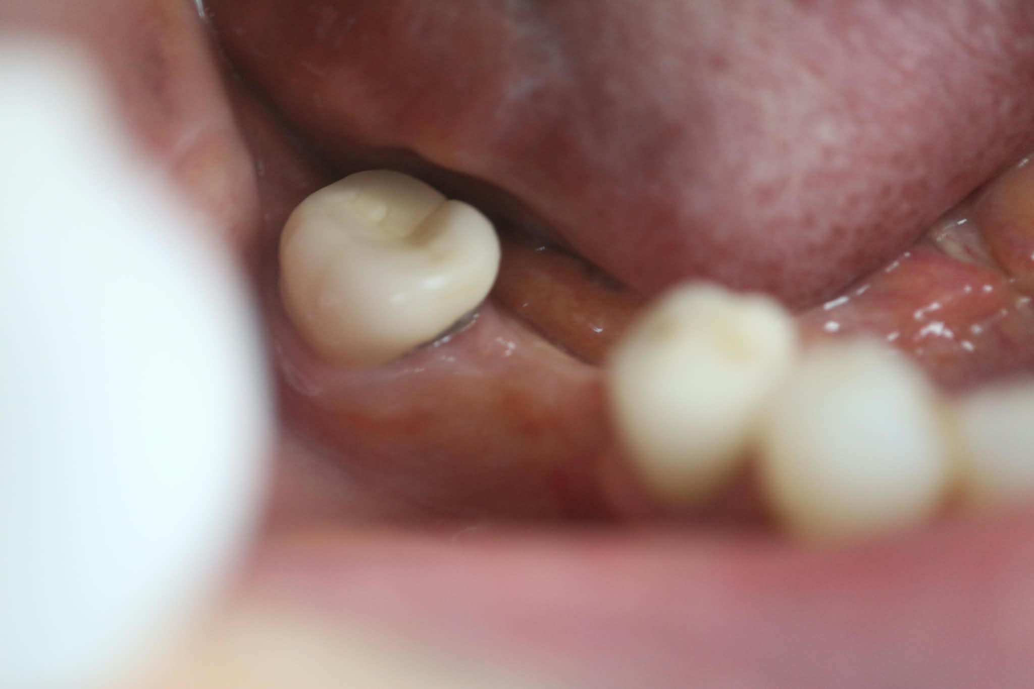 Before: Missing molar prior to single tooth implant placement