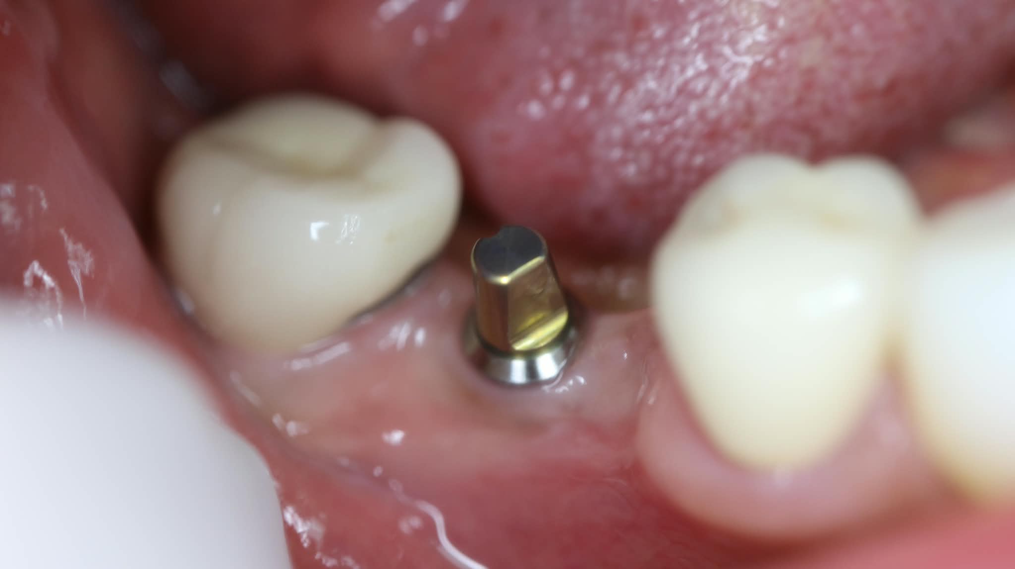 Procedure: Placement of biocompatible implant fixture for single tooth replacement