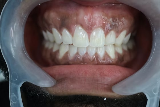 After: Corrected dental arch alignment following completed Invisalign aligner therapy