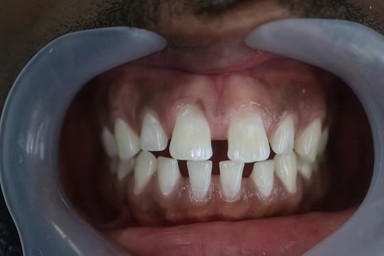 Before: Severe dental arch crowding and misalignment prior to Invisalign