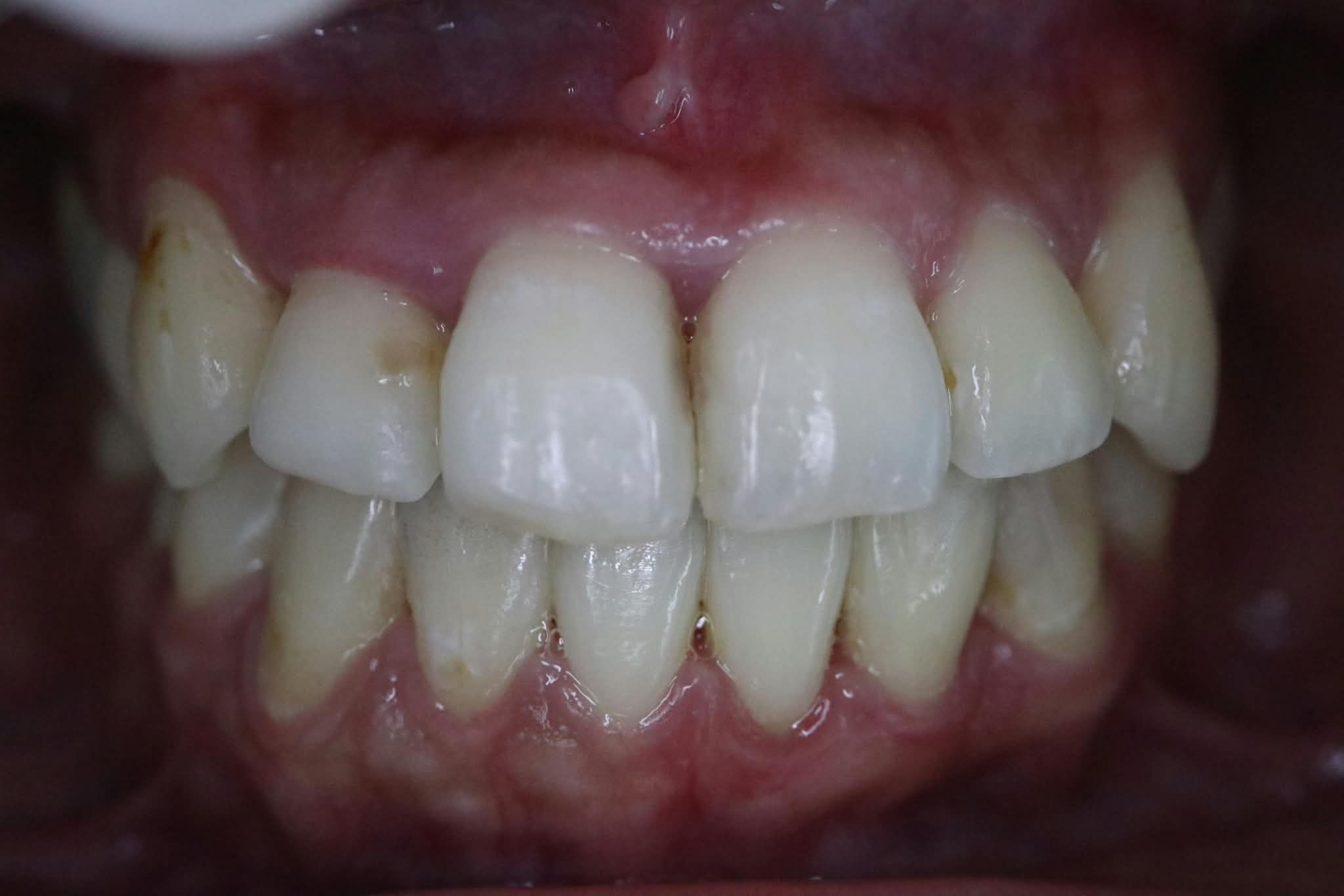 After: Balanced anterior guidance and leveled dental bite