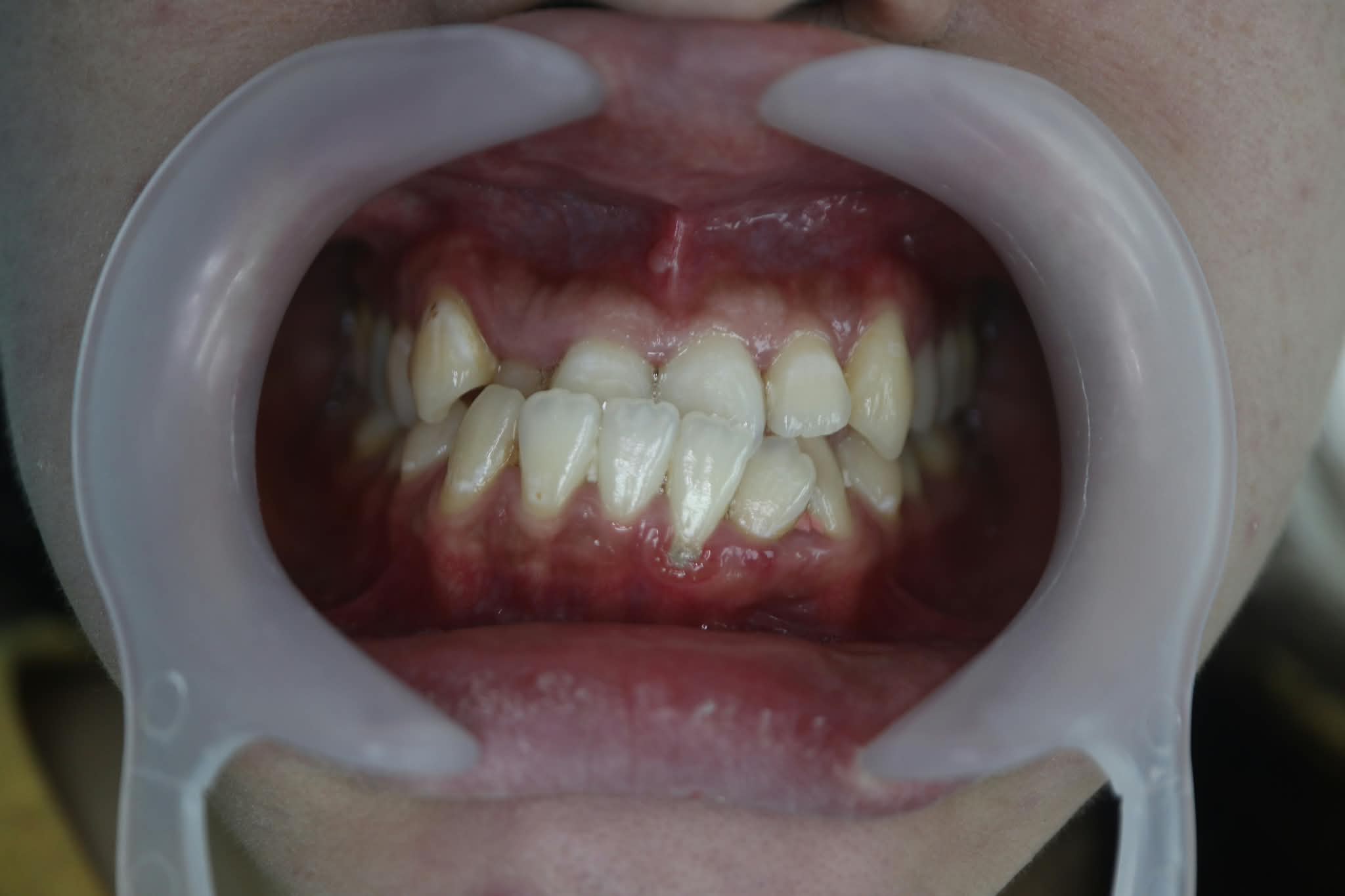 Before: Deep overbite causing functional wear and anterior overlap