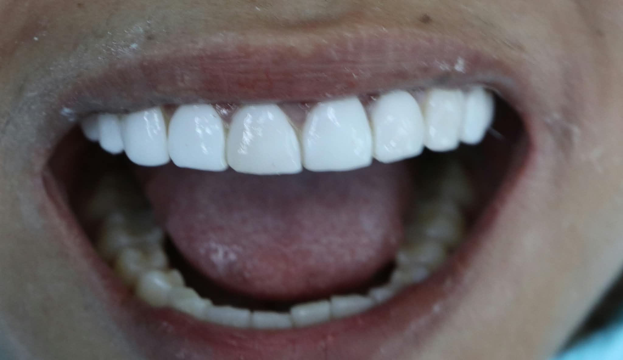 After: Restored natural aesthetics with direct composite veneers by Dr. Benjamin Lee