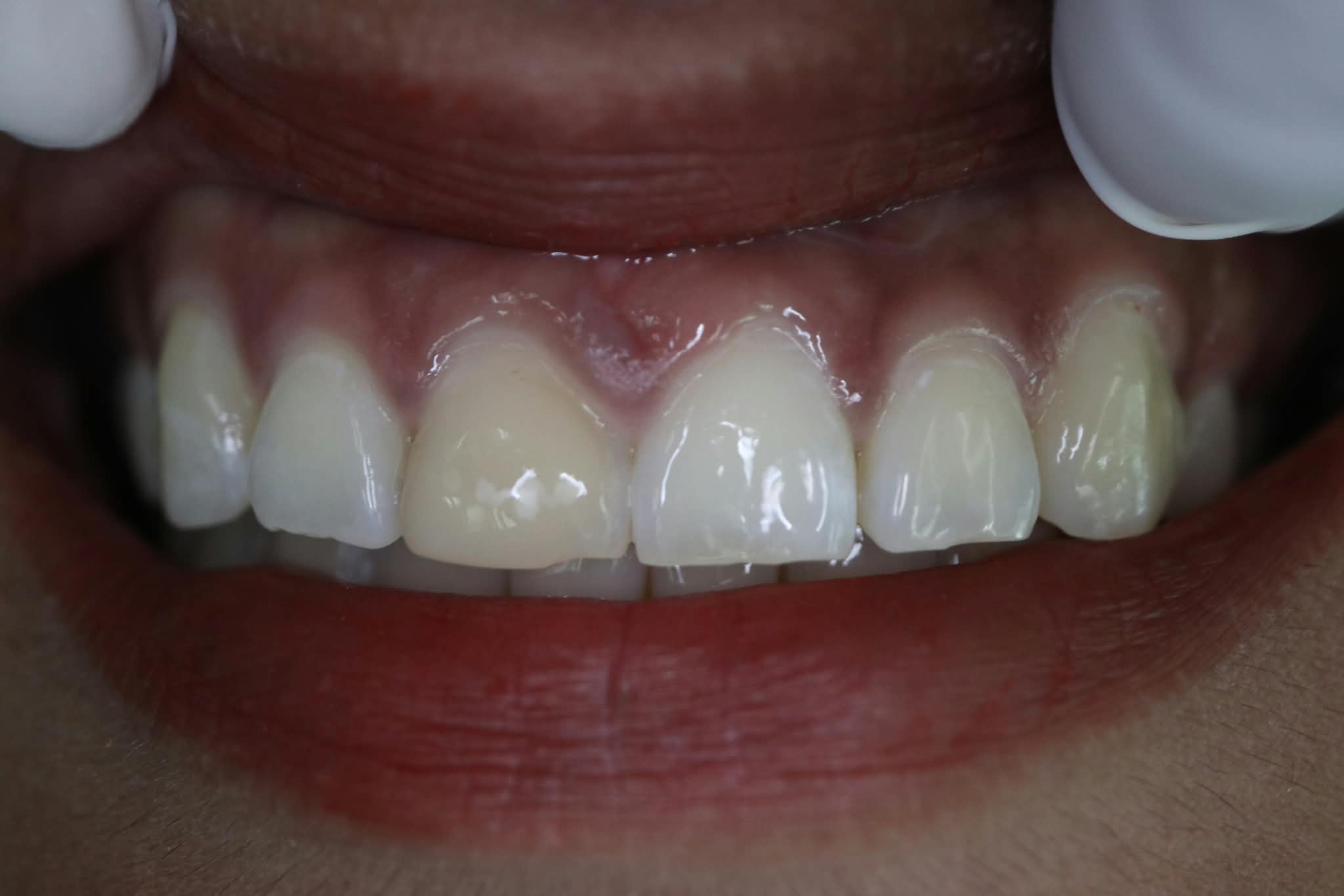 Before: Enamel wear and discoloration prior to composite veneers smile makeover